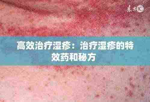 高效治疗湿疹:治疗湿疹的特效药和秘方