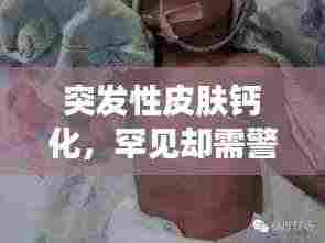 突发性皮肤钙化,罕见却需警惕的皮肤病